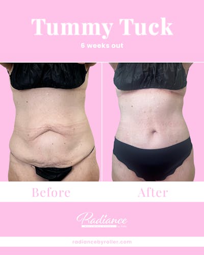 Tummy Tuck Before & After Gallery - Patient 933831 - Image 1