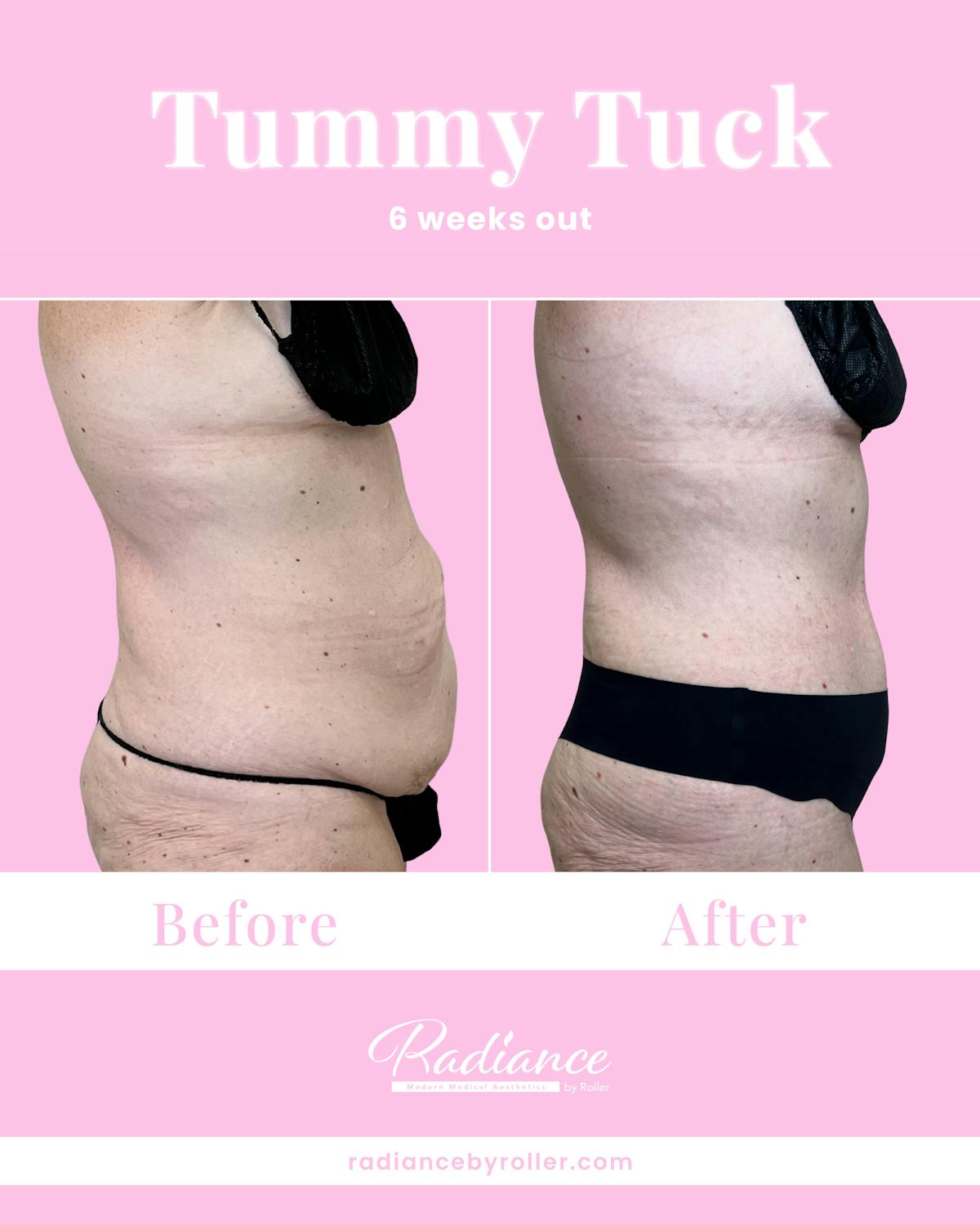 Tummy Tuck Before & After Gallery - Patient 933831 - Image 3