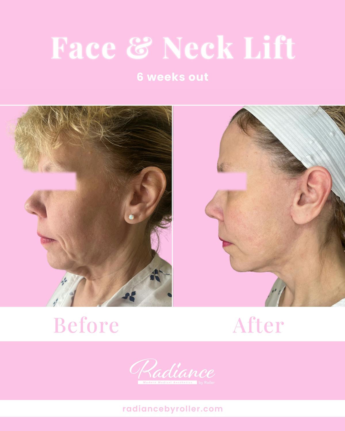 Facelift Before & After Gallery - Patient 234345 - Image 2