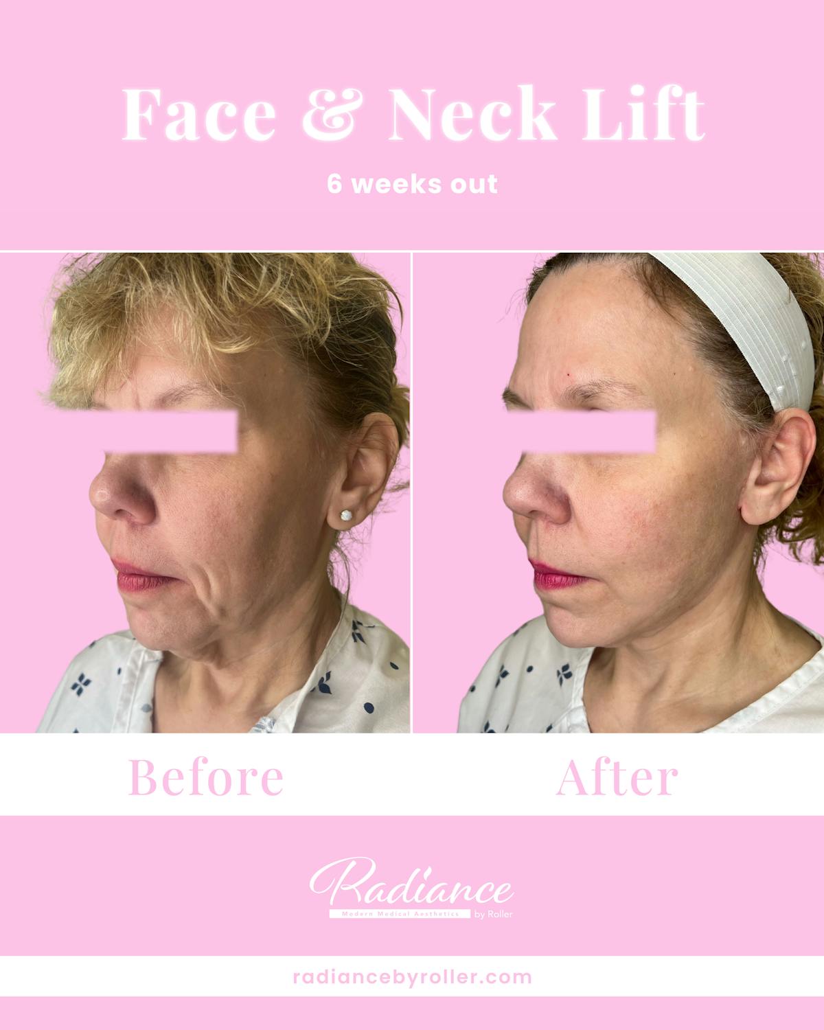 Facelift Before & After Gallery - Patient 234345 - Image 1