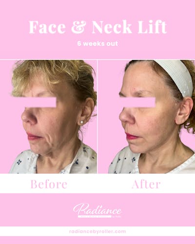 Facelift Before & After Gallery - Patient 234345 - Image 1