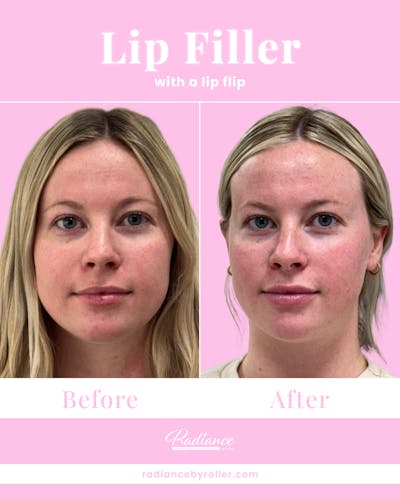 Fillers Before & After Gallery - Patient 329658 - Image 1