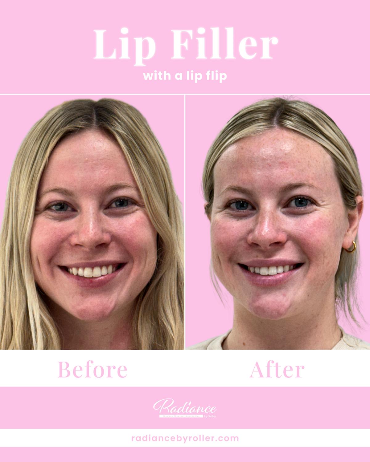 Fillers Before & After Gallery - Patient 329658 - Image 2