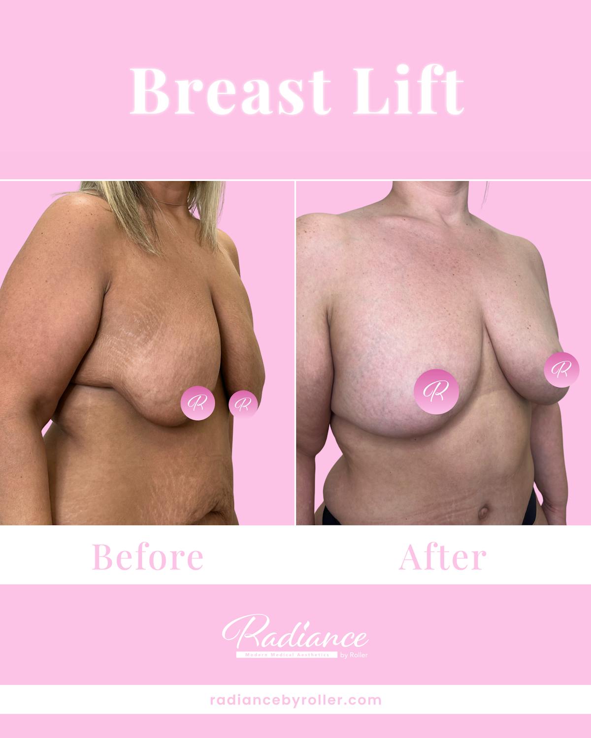 Breast Lift Before & After Gallery - Patient 323092 - Image 2