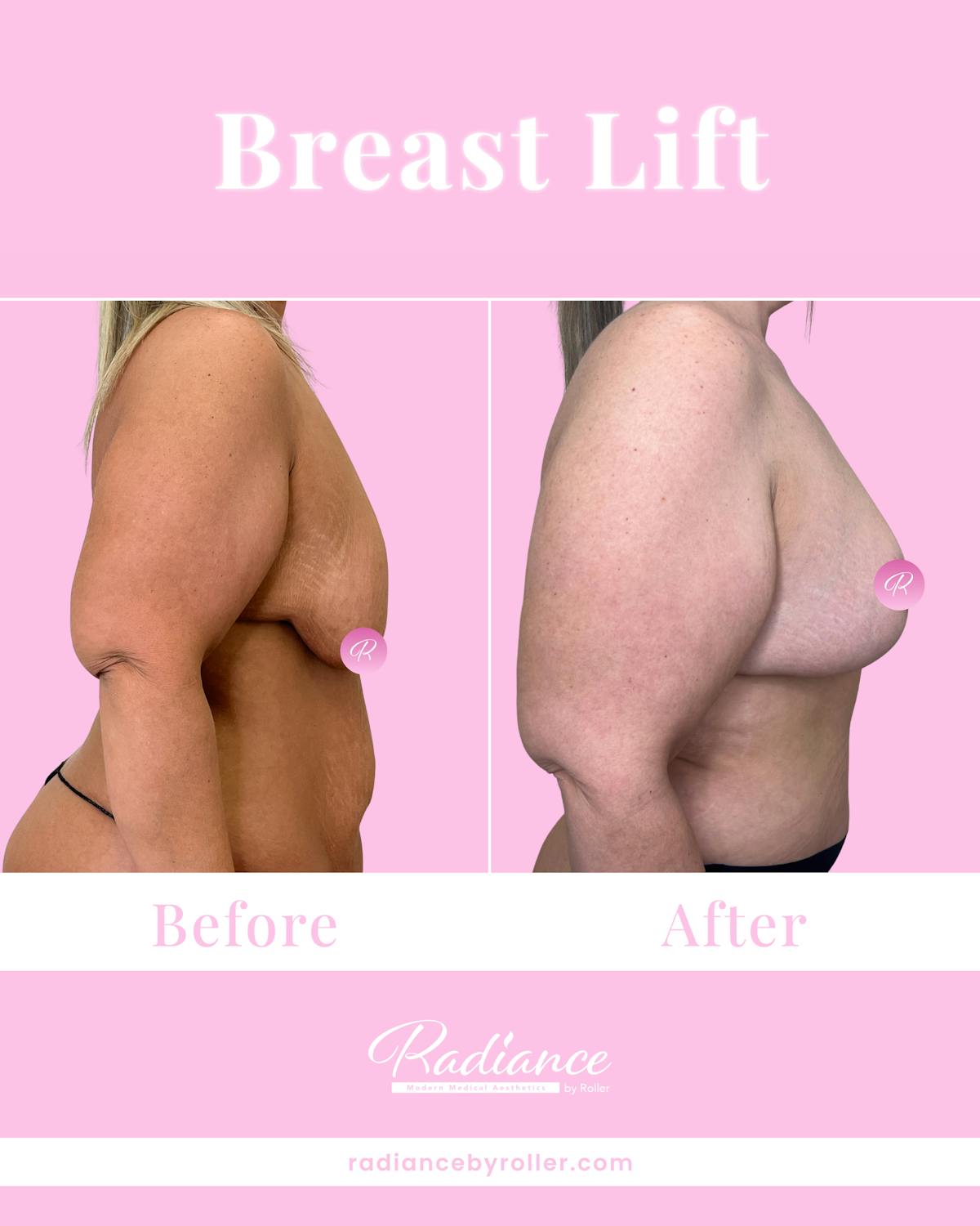 Breast Lift Before & After Gallery - Patient 323092 - Image 3