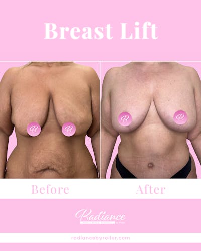 Breast Lift Before & After Gallery - Patient 323092 - Image 1