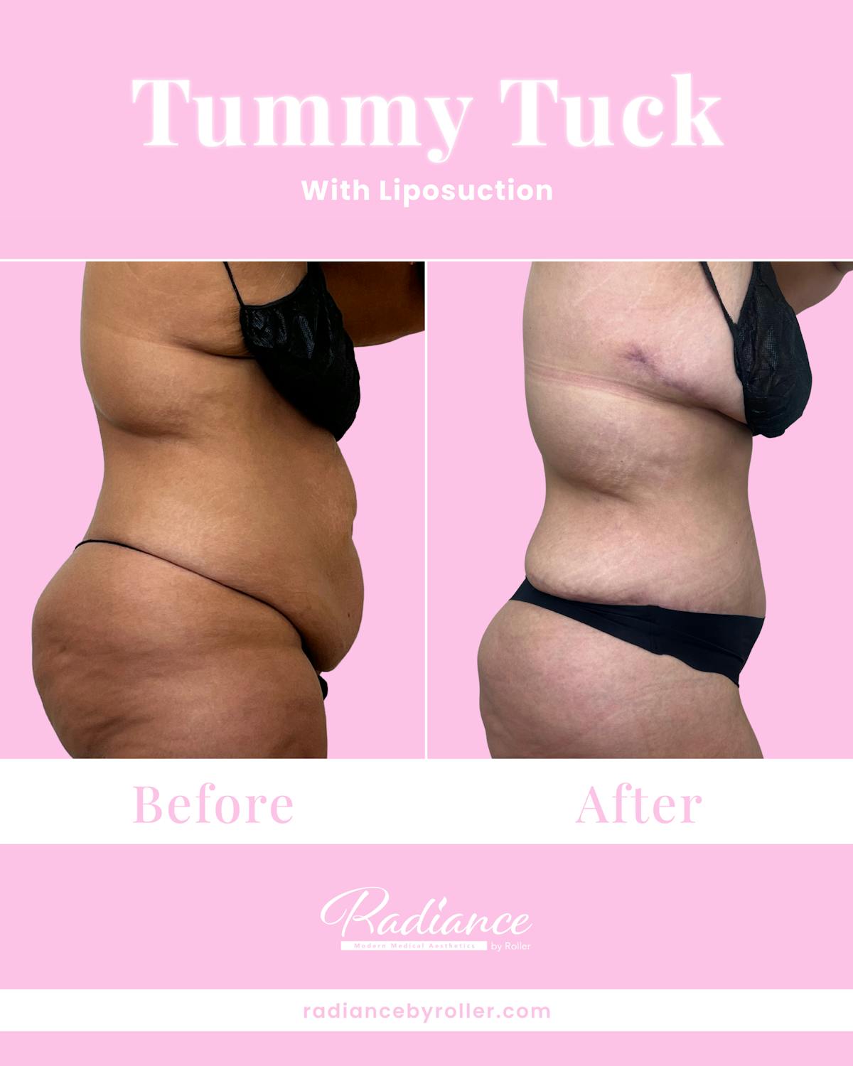 Tummy Tuck Before & After Gallery - Patient 557414 - Image 2