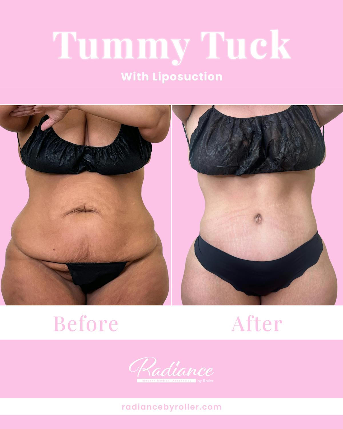 Tummy Tuck Before & After Gallery - Patient 557414 - Image 1