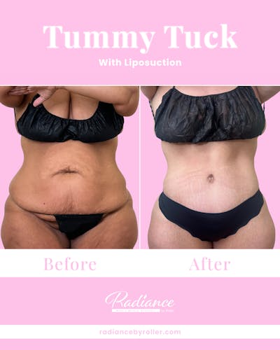 Tummy Tuck Before & After Gallery - Patient 557414 - Image 1