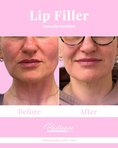 Fillers Before & After Gallery - Patient 170365 - Image 1
