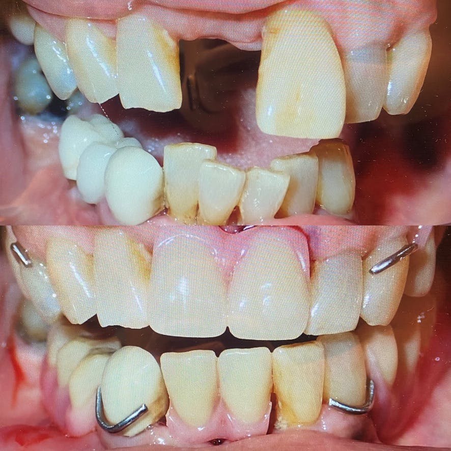 Removable Dentures Before & After Gallery - Patient 86636725 - Image 1