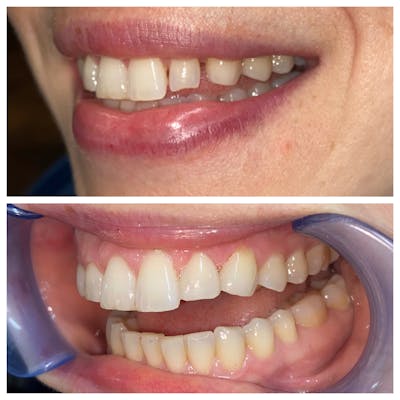 Cosmetic Bonding Before & After Gallery - Patient 86636726 - Image 1