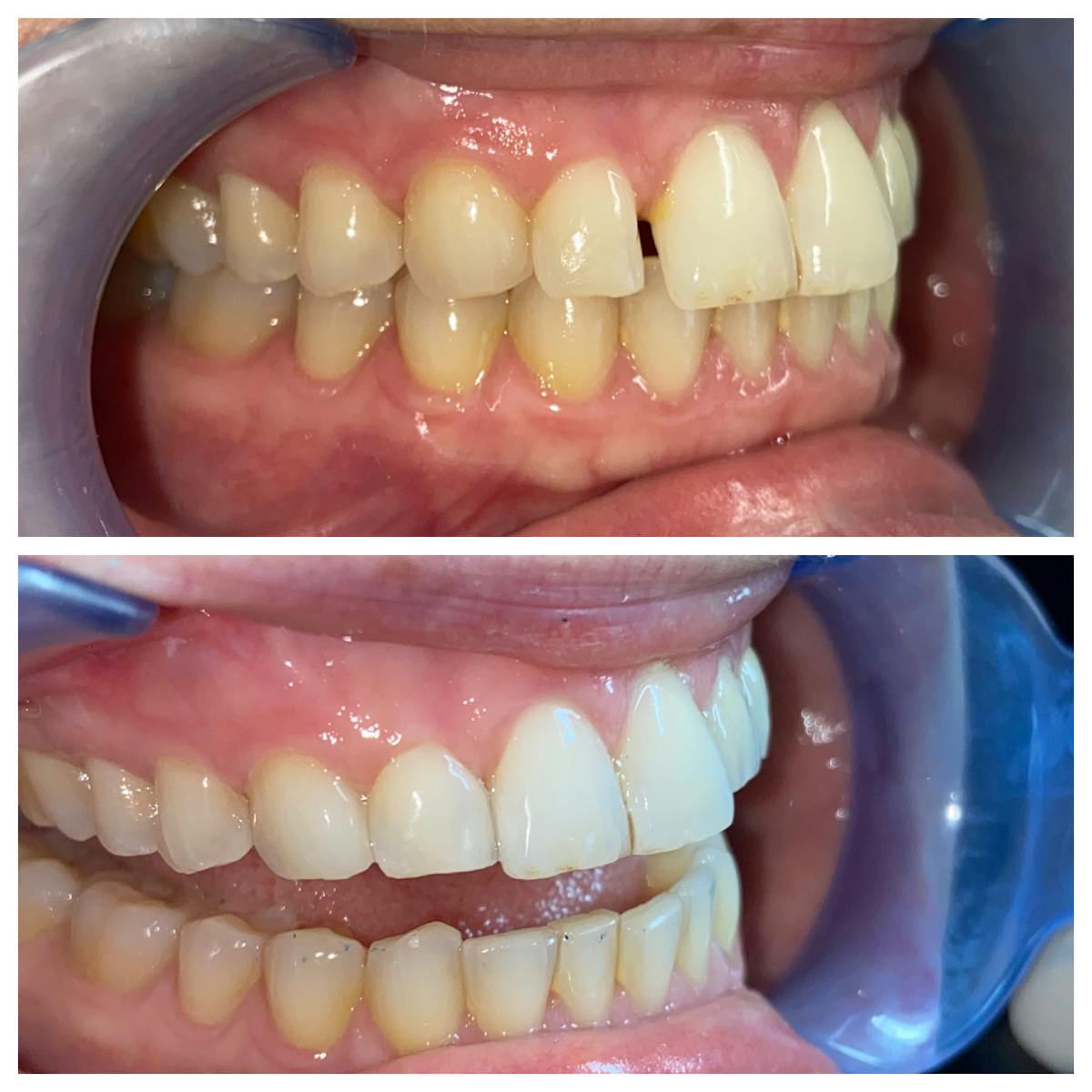 Cosmetic Bonding Before & After Gallery - Patient 86636726 - Image 2