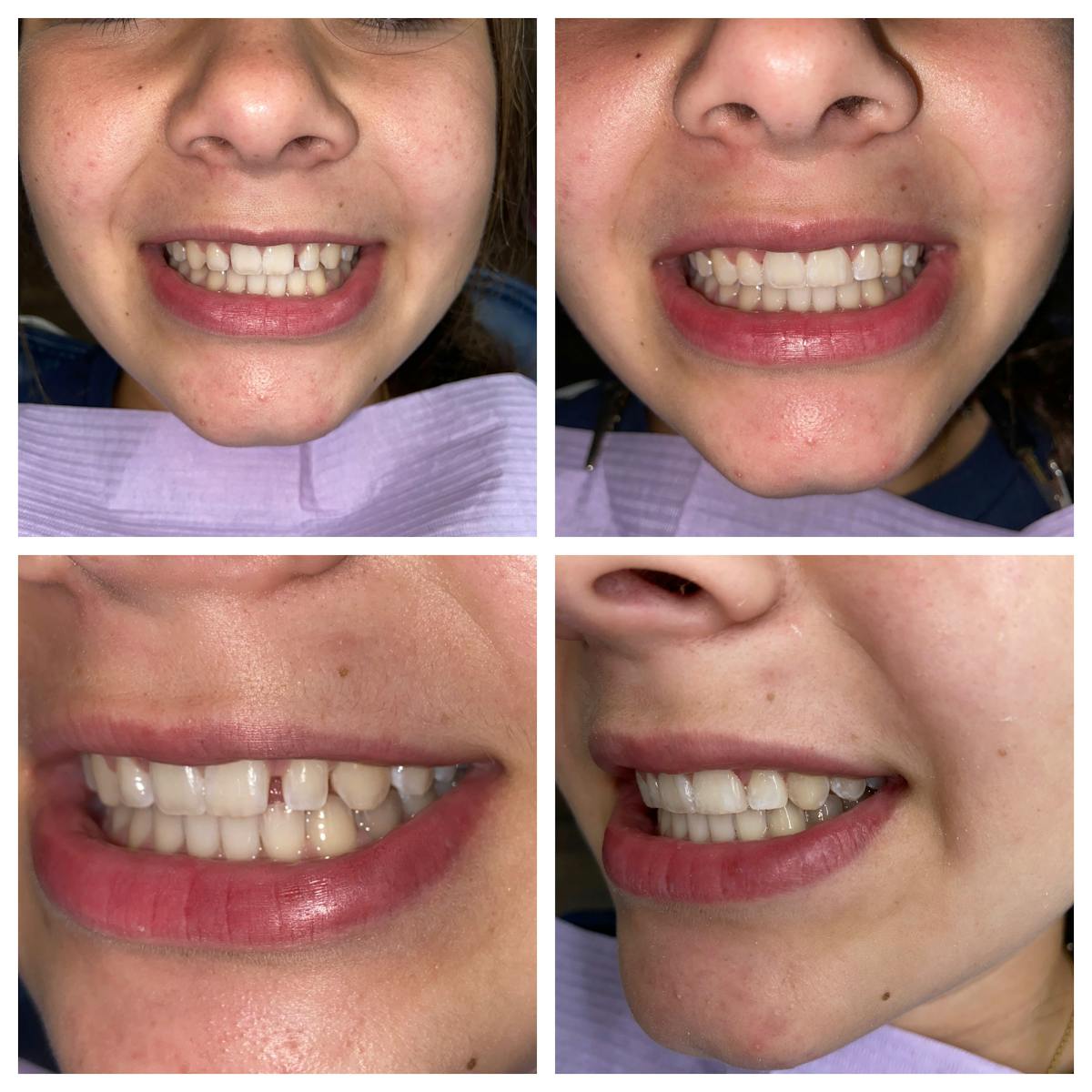 Cosmetic Bonding Before & After Gallery - Patient 86636731 - Image 2
