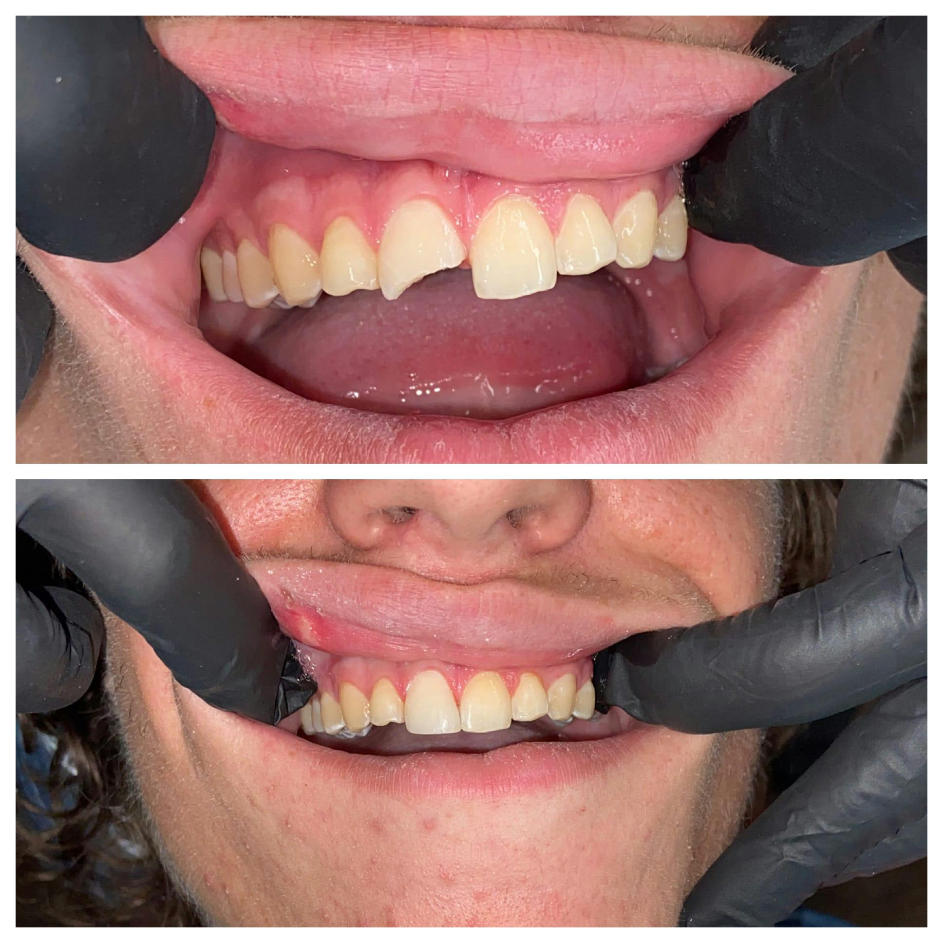 Cosmetic Bonding Before & After Gallery - Patient 86636732 - Image 1