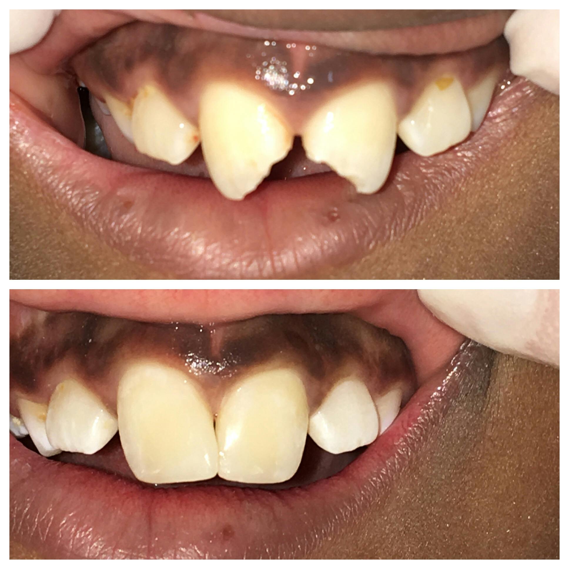 Cosmetic Bonding Before & After Gallery - Patient 86636733 - Image 1