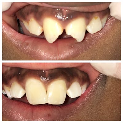 Cosmetic Bonding Before & After Gallery - Patient 86636733 - Image 1