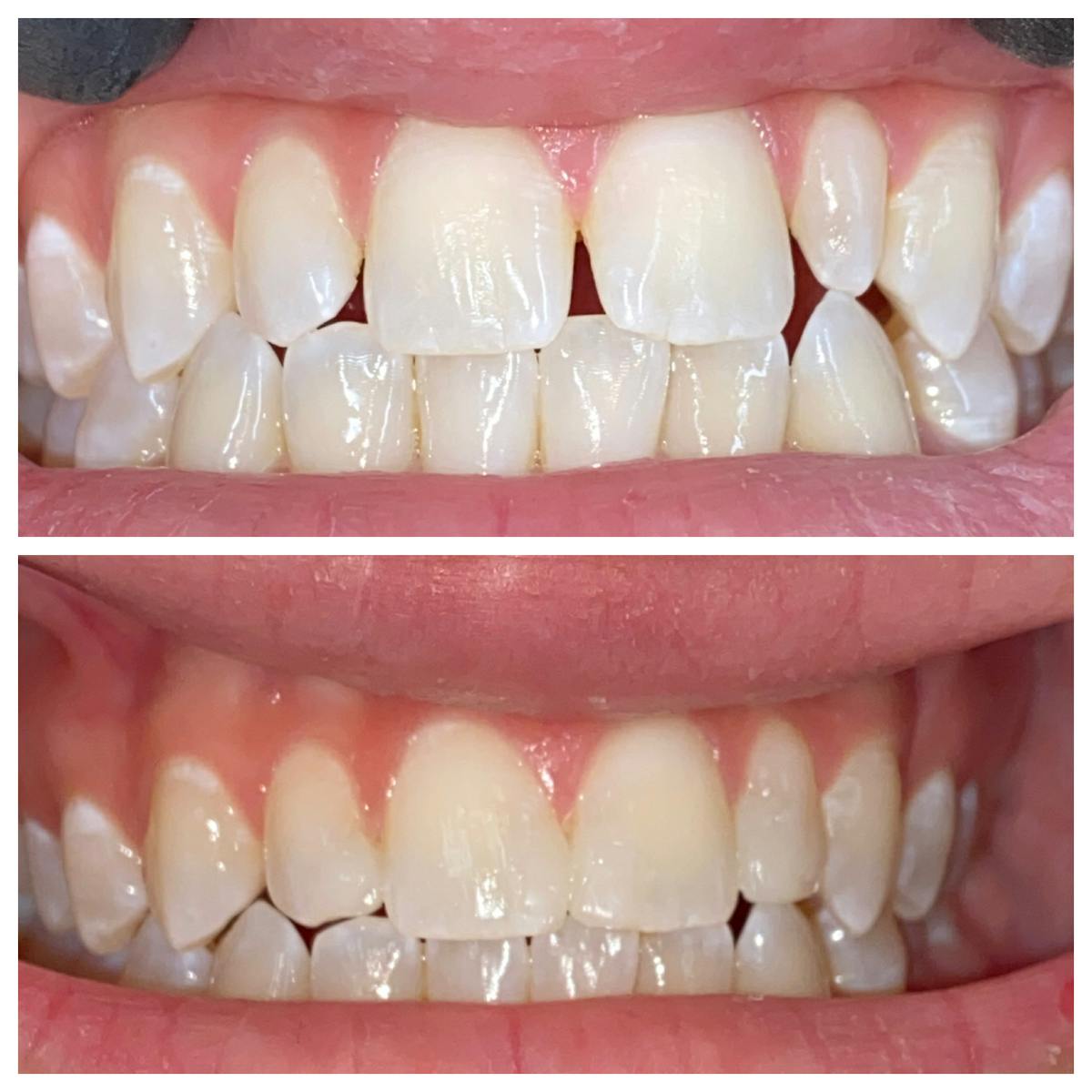 Cosmetic Bonding Before & After Gallery - Patient 86636734 - Image 1