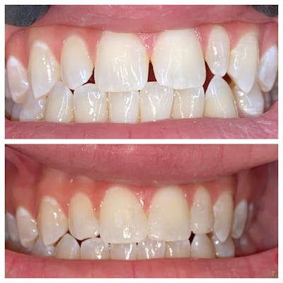 Cosmetic Bonding Before & After Gallery - Patient 86636734 - Image 1