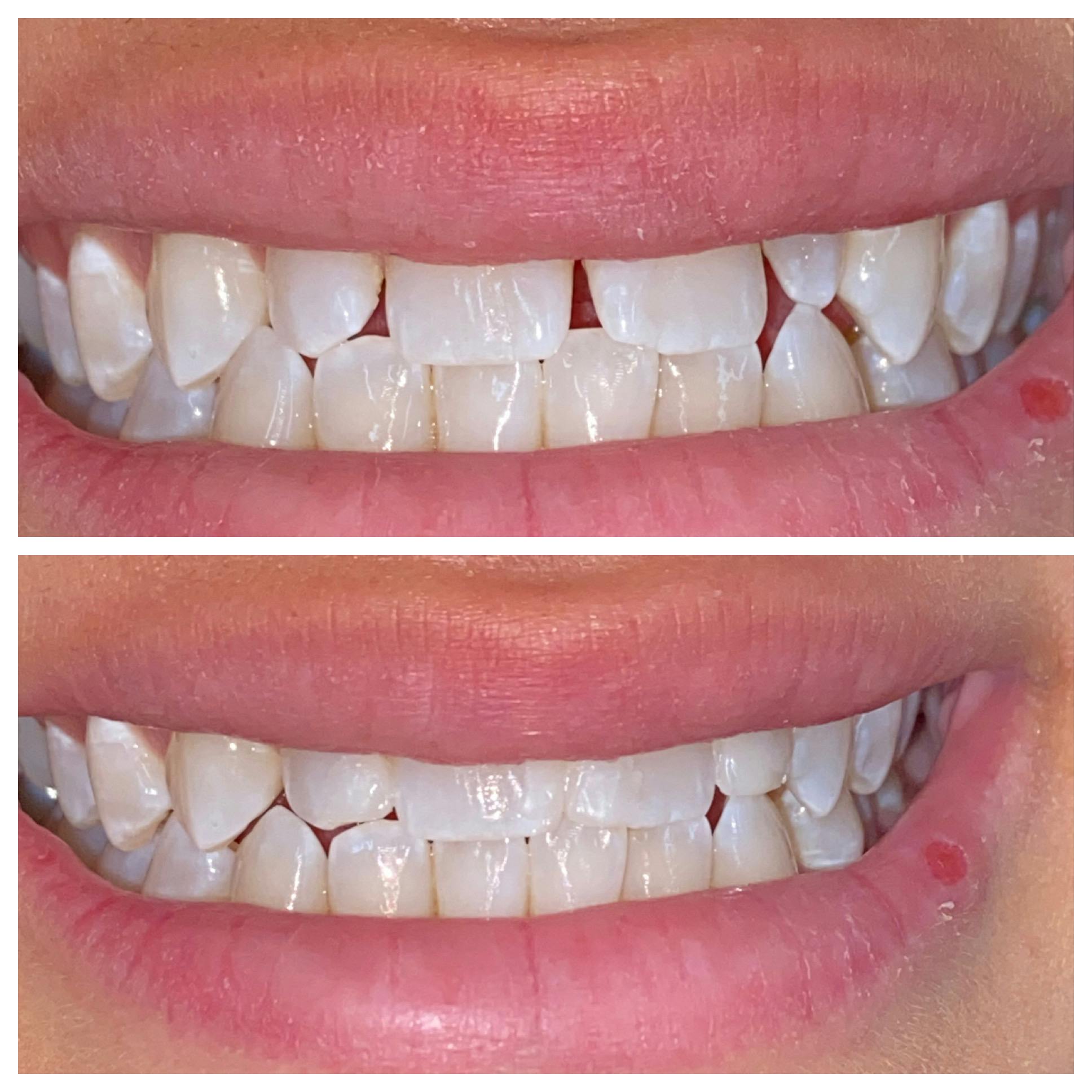 Cosmetic Bonding Before & After Gallery - Patient 86636734 - Image 2