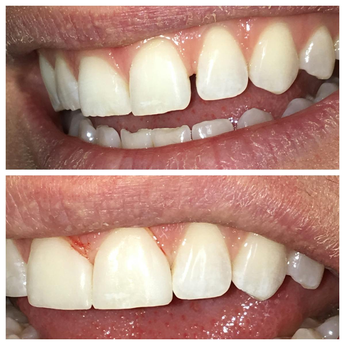 Cosmetic Bonding Before & After Gallery - Patient 86636735 - Image 1