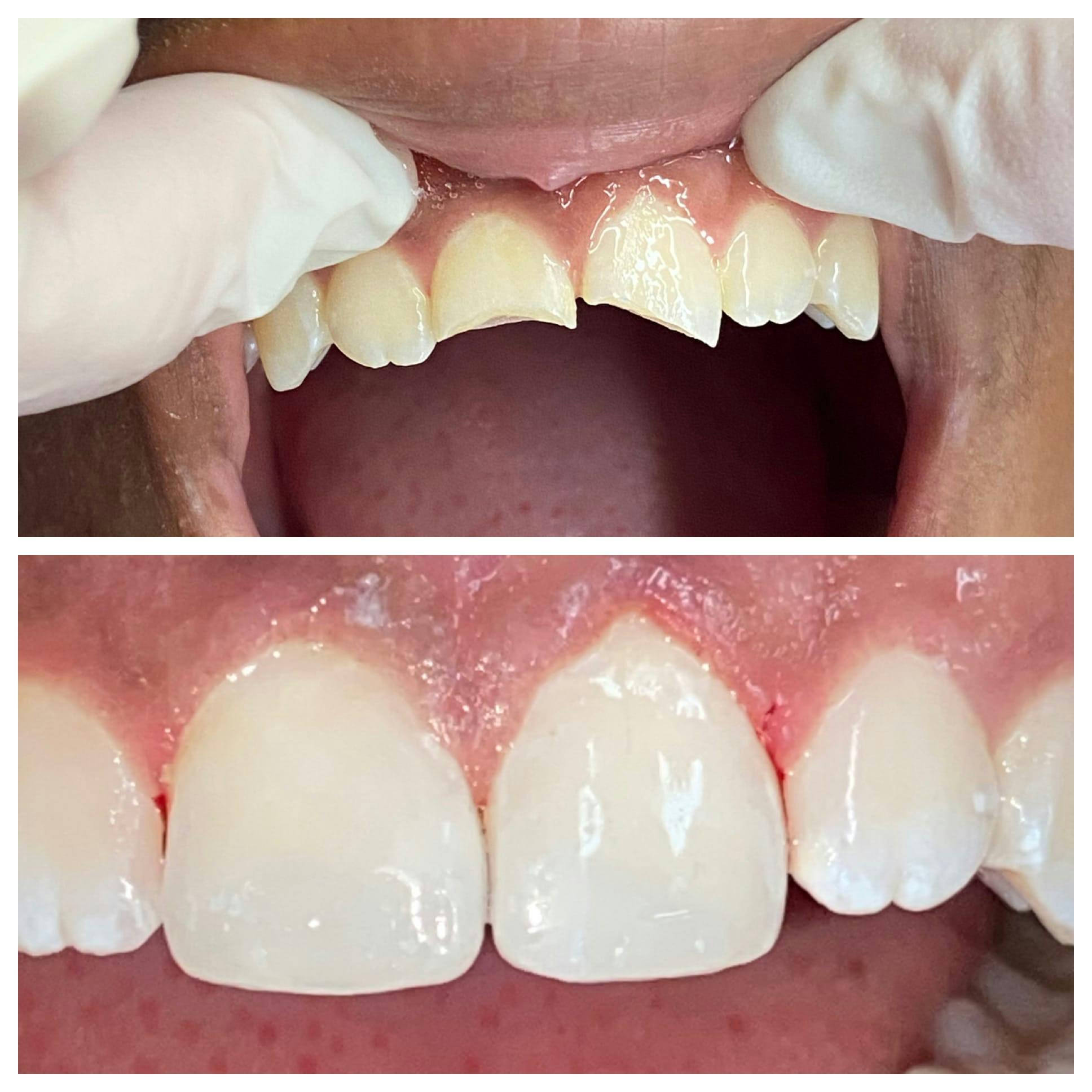 Cosmetic Bonding Before & After Gallery - Patient 86636736 - Image 1