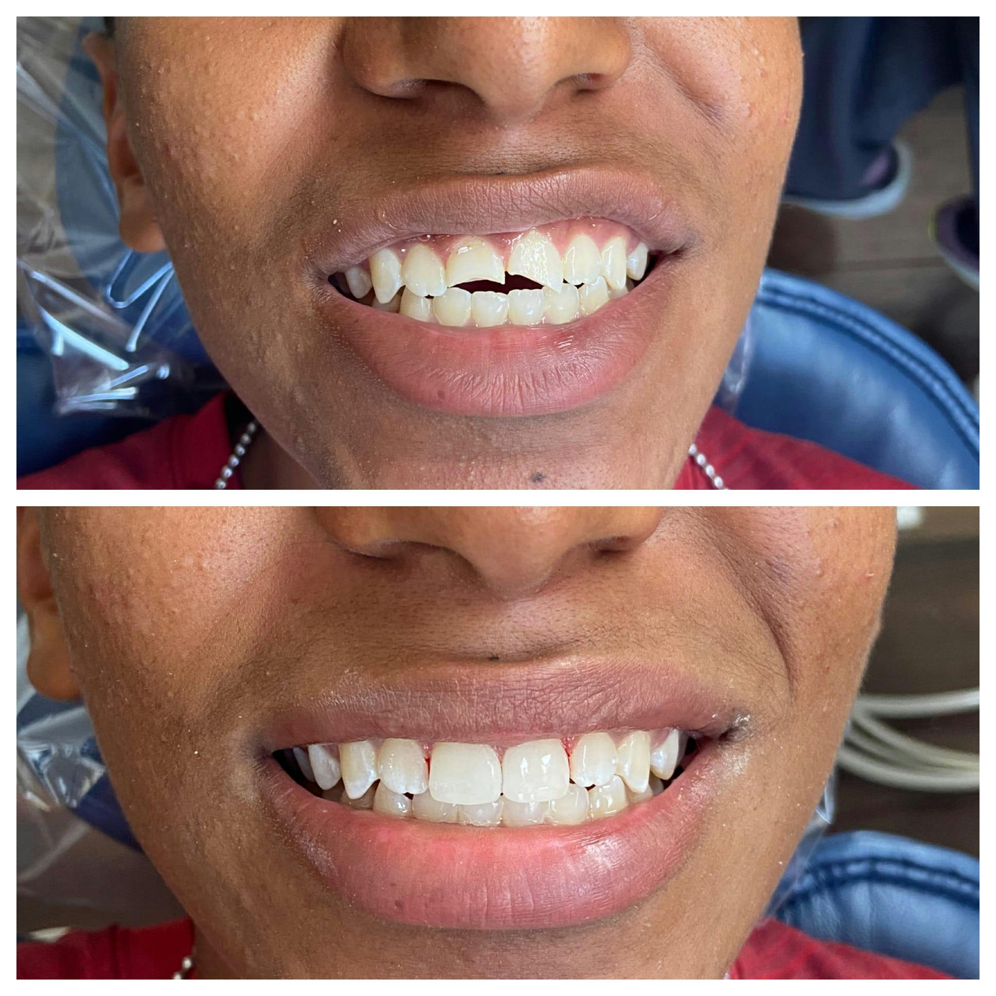 Cosmetic Bonding Before & After Gallery - Patient 86636736 - Image 2