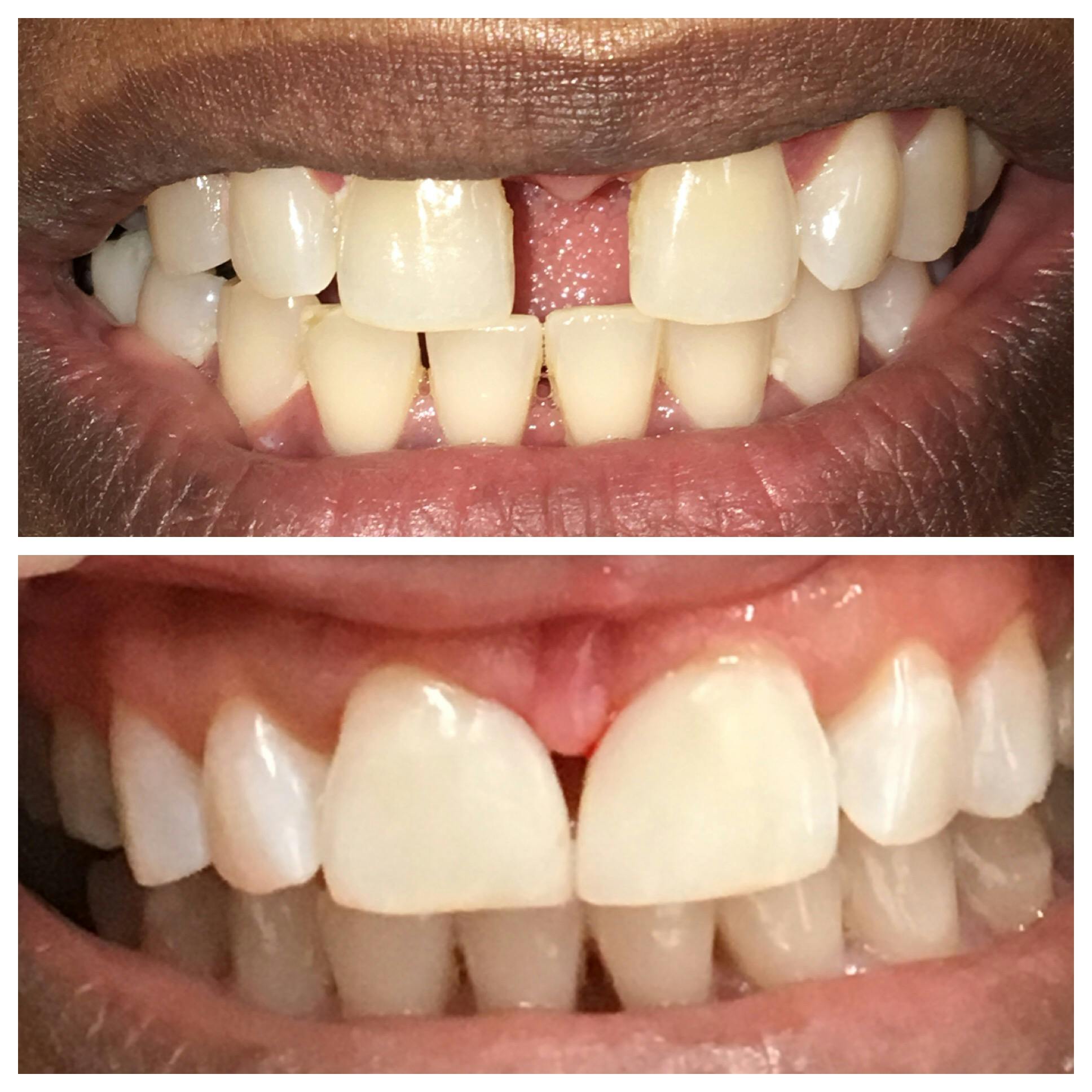 Cosmetic Bonding Before & After Gallery - Patient 86636737 - Image 1