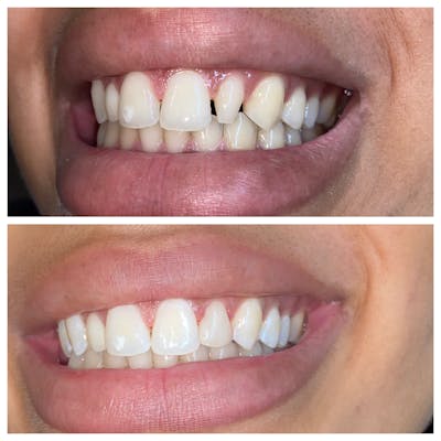 Cosmetic Bonding Before & After Gallery - Patient 86636738 - Image 1