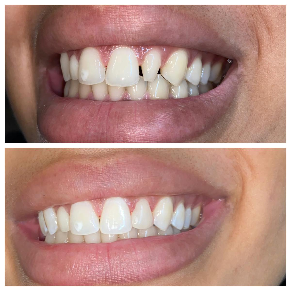 Cosmetic Bonding Before & After Gallery - Patient 86636738 - Image 1
