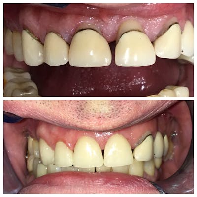 Crowns Before & After Gallery - Patient 86637809 - Image 1
