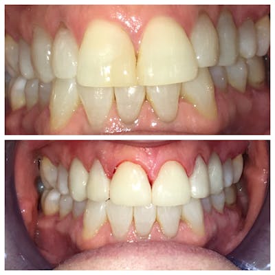Crowns Before & After Gallery - Patient 86637810 - Image 1