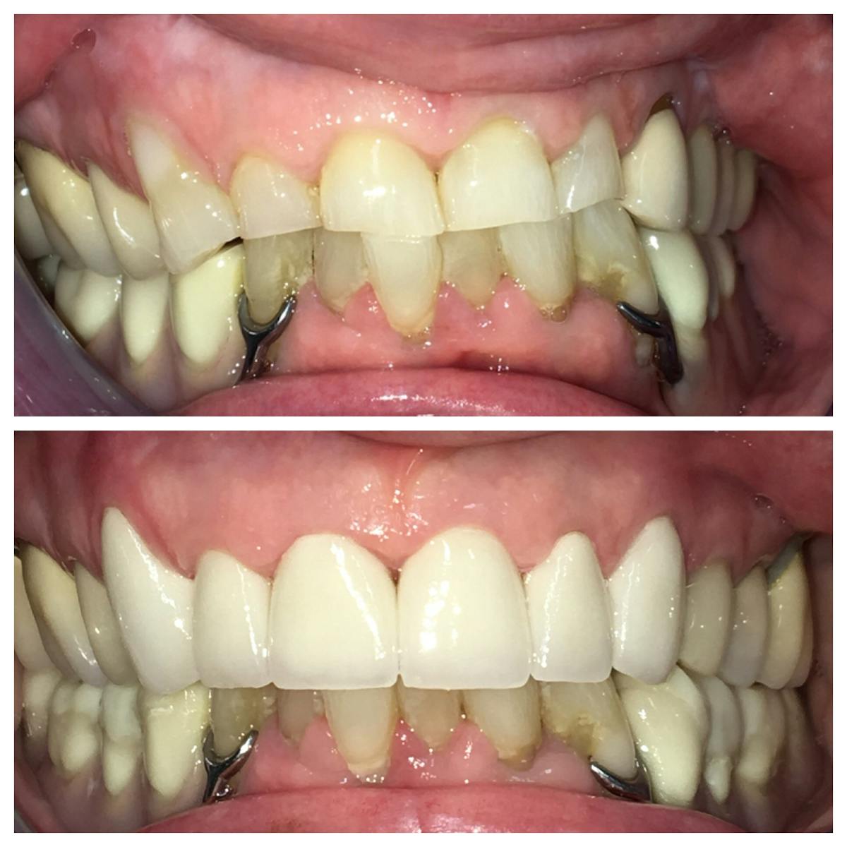 Crowns Before & After Gallery - Patient 86637812 - Image 2