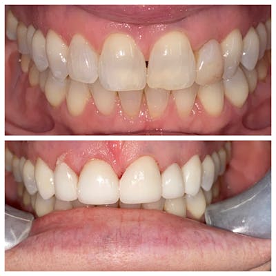 Crowns Before & After Gallery - Patient 86637813 - Image 1