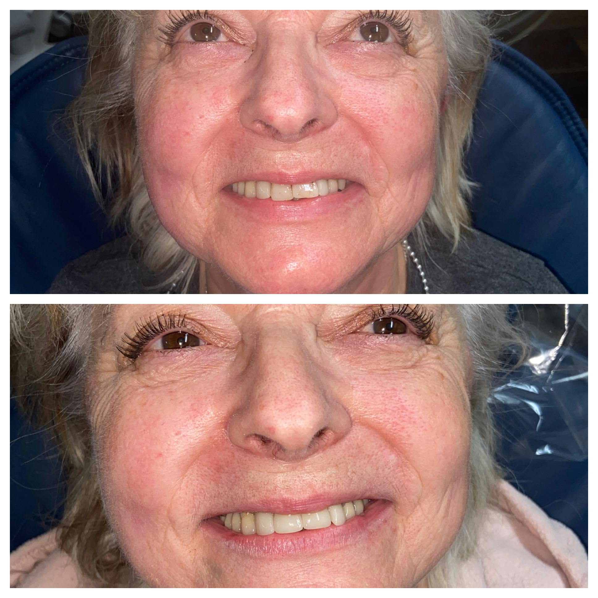 Crowns Before & After Gallery - Patient 86637814 - Image 1