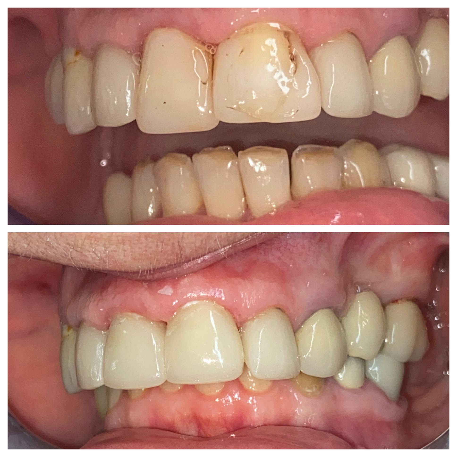 Crowns Before & After Gallery - Patient 86637814 - Image 2