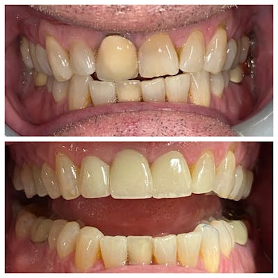 Crowns Before & After Gallery - Patient 86637816 - Image 1