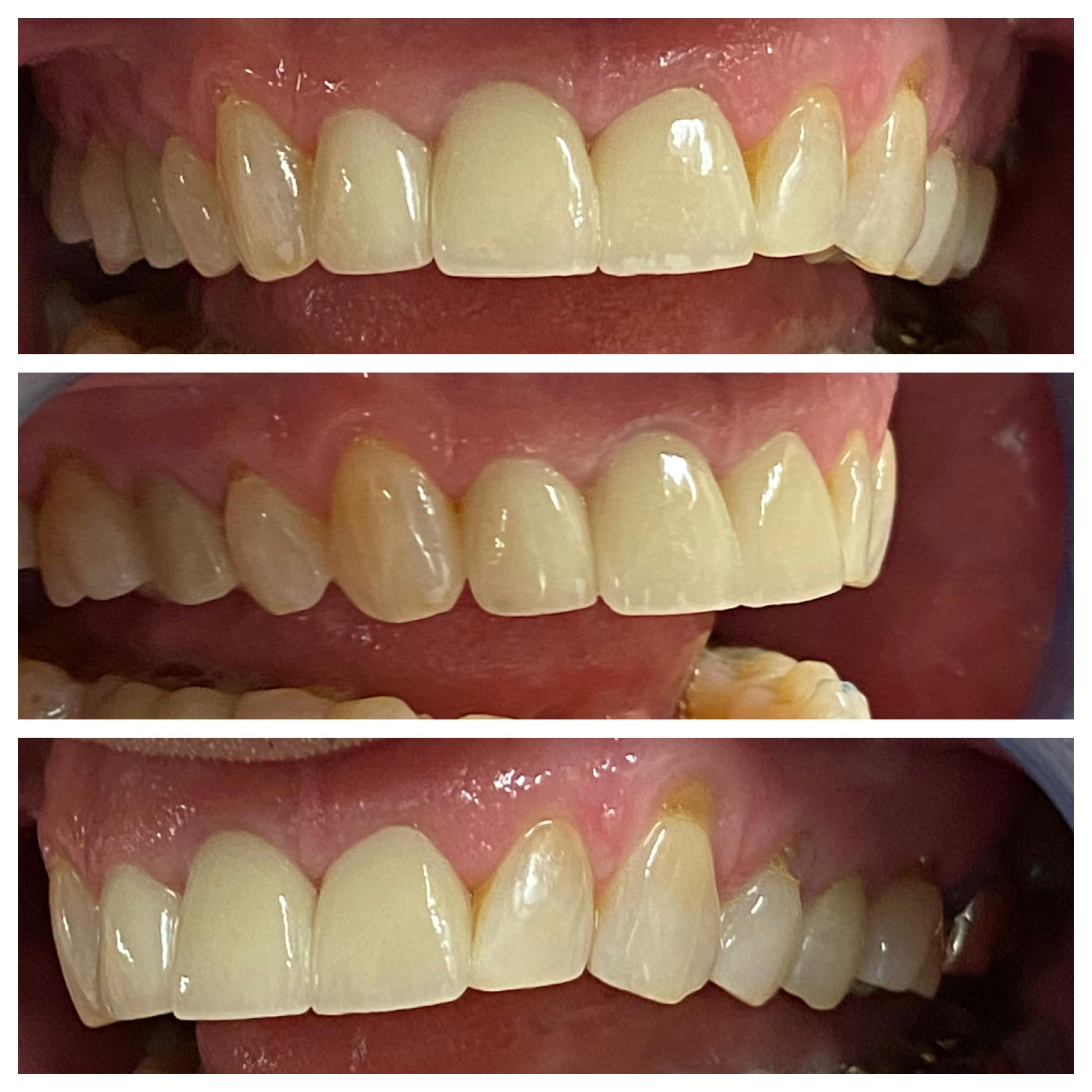 Crowns Before & After Gallery - Patient 86637816 - Image 2