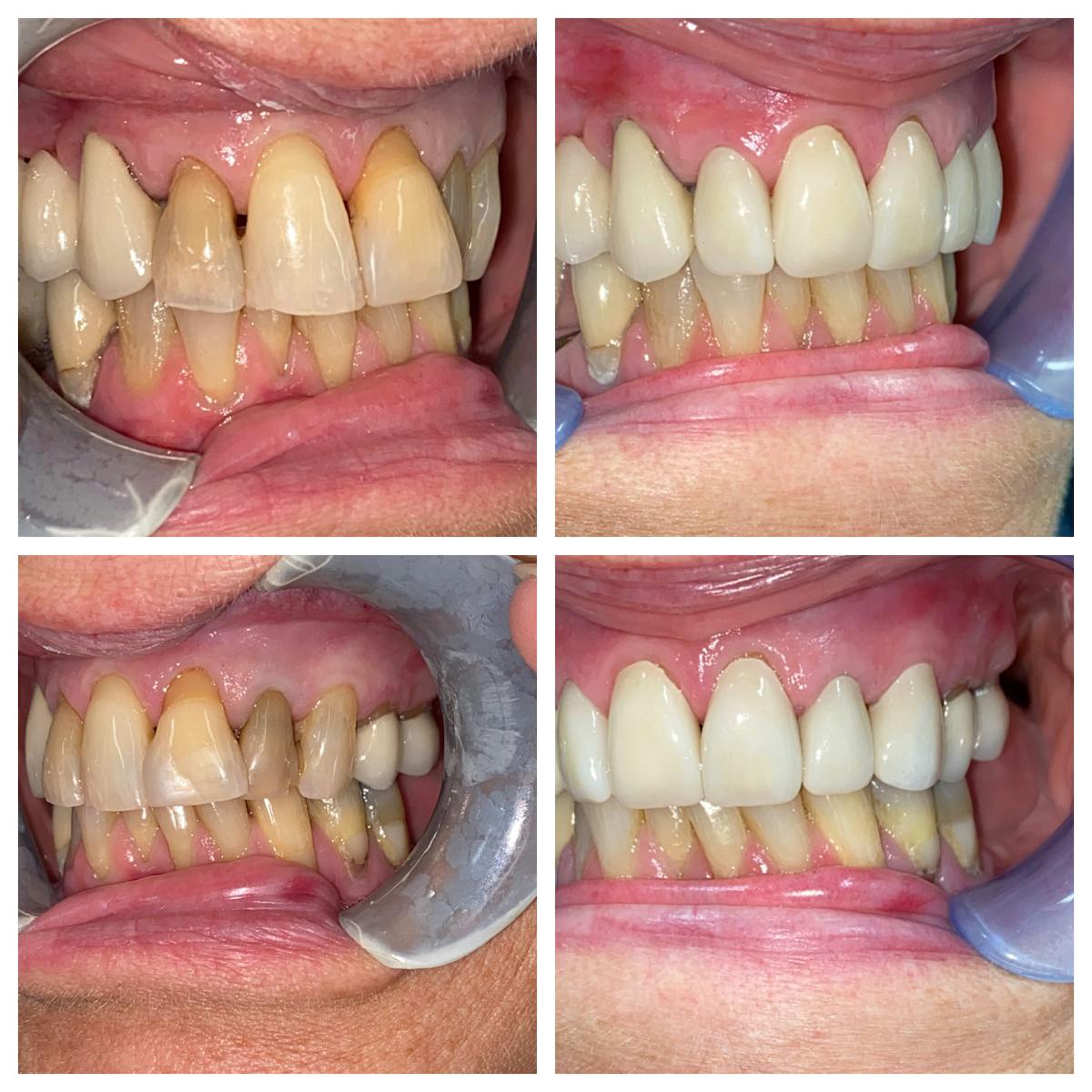 Crowns Before & After Gallery - Patient 86637817 - Image 1