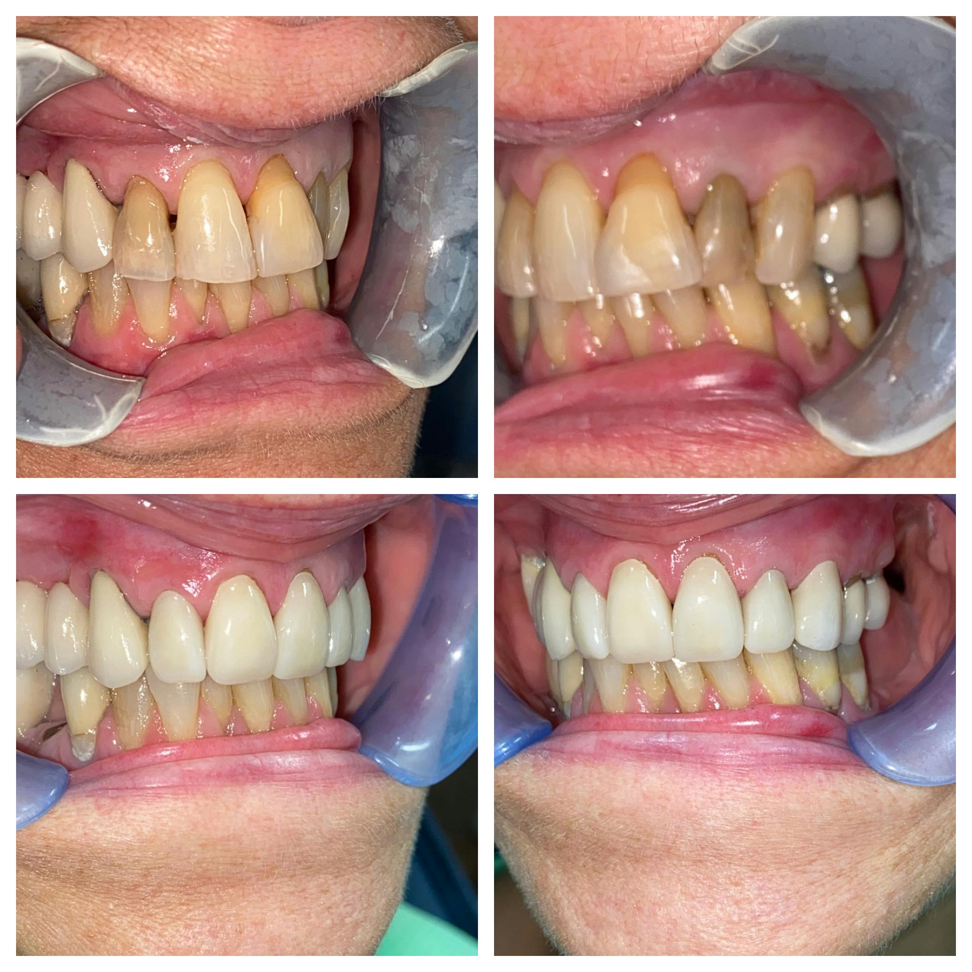 Crowns Before & After Gallery - Patient 86637817 - Image 2