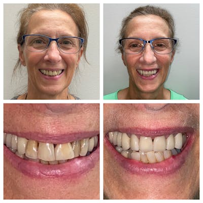 Crowns Before & After Gallery - Patient 86637818 - Image 1