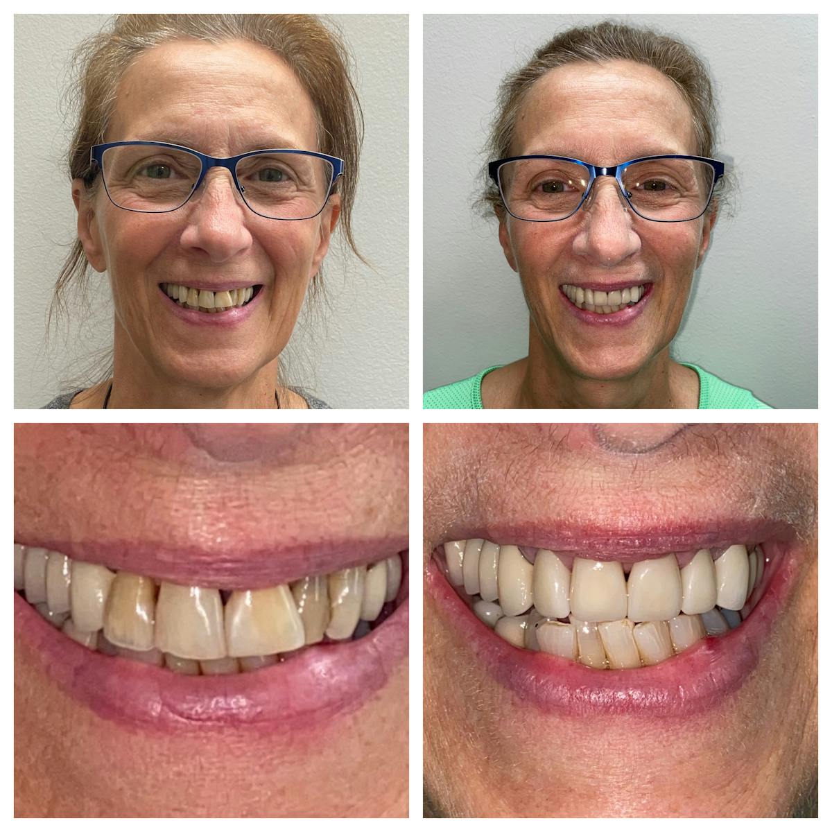 Crowns Before & After Gallery - Patient 86637818 - Image 1
