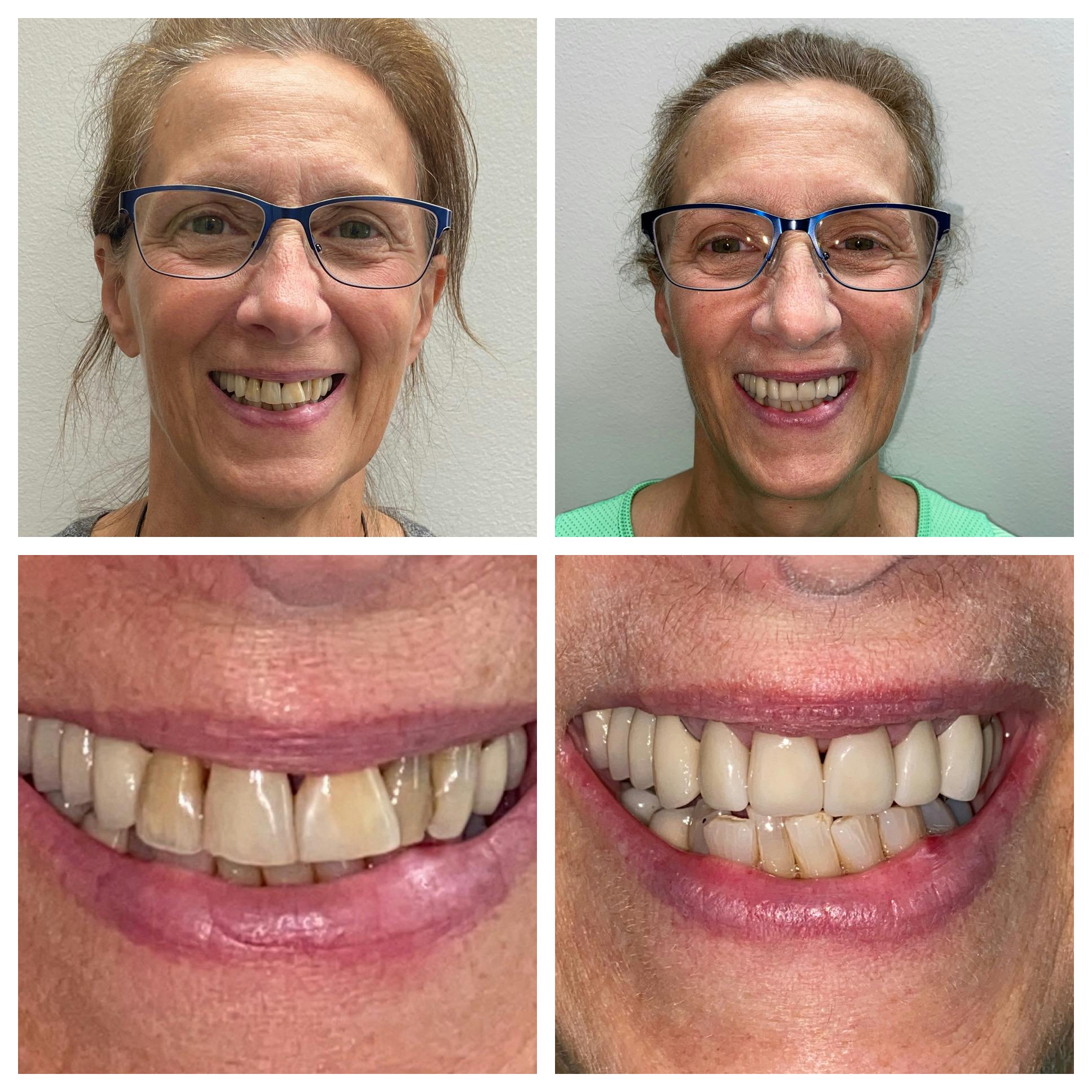 Crowns Before & After Gallery - Patient 86637818 - Image 1