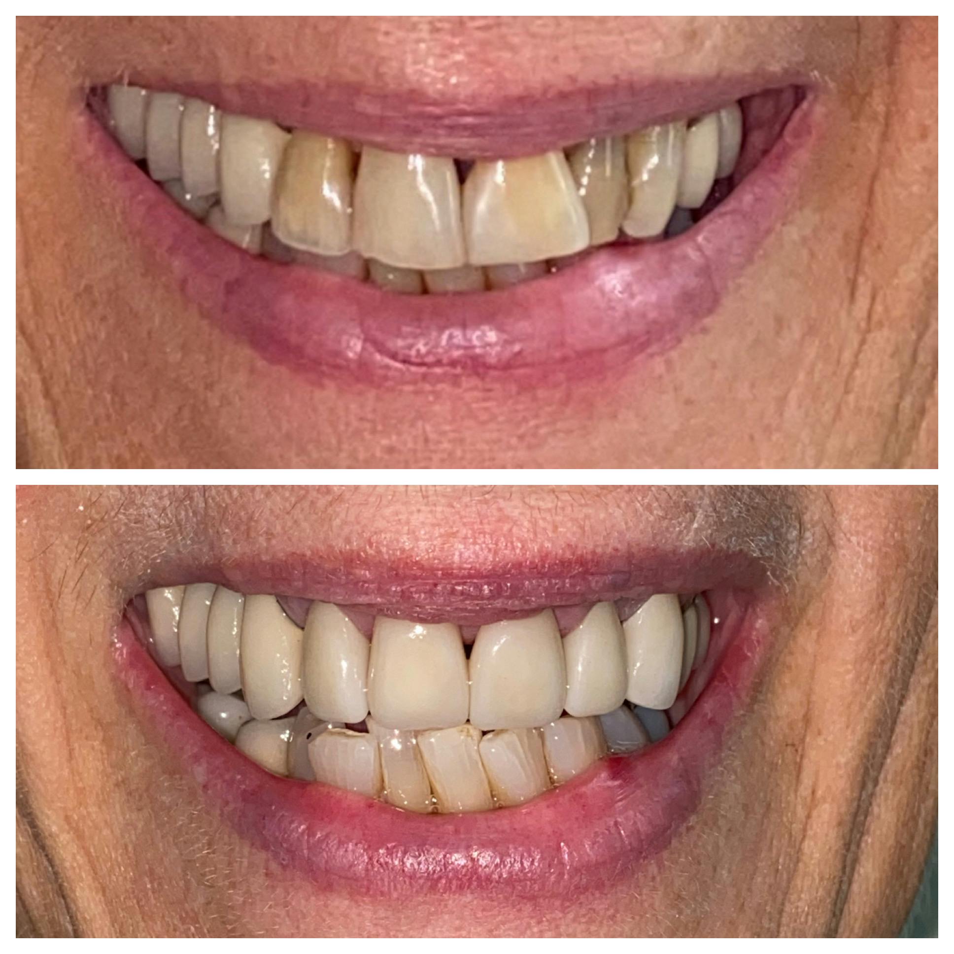 Crowns Before & After Gallery - Patient 86637818 - Image 2