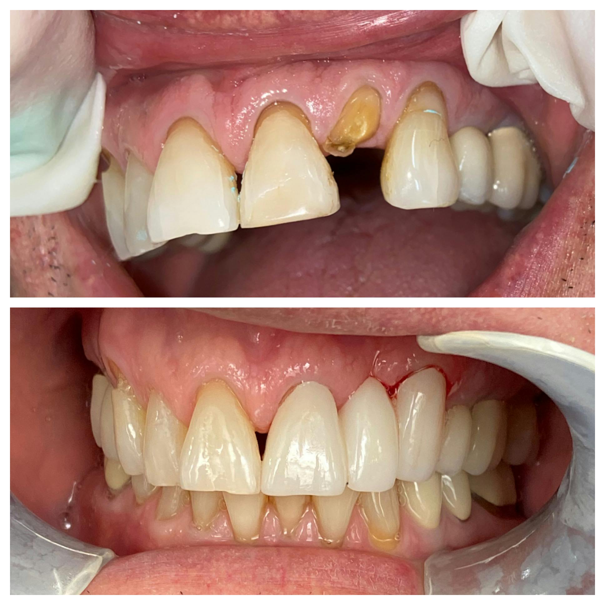 Crowns Before & After Gallery - Patient 86637819 - Image 1