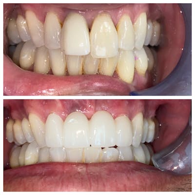 Crowns Before & After Gallery - Patient 86637820 - Image 1