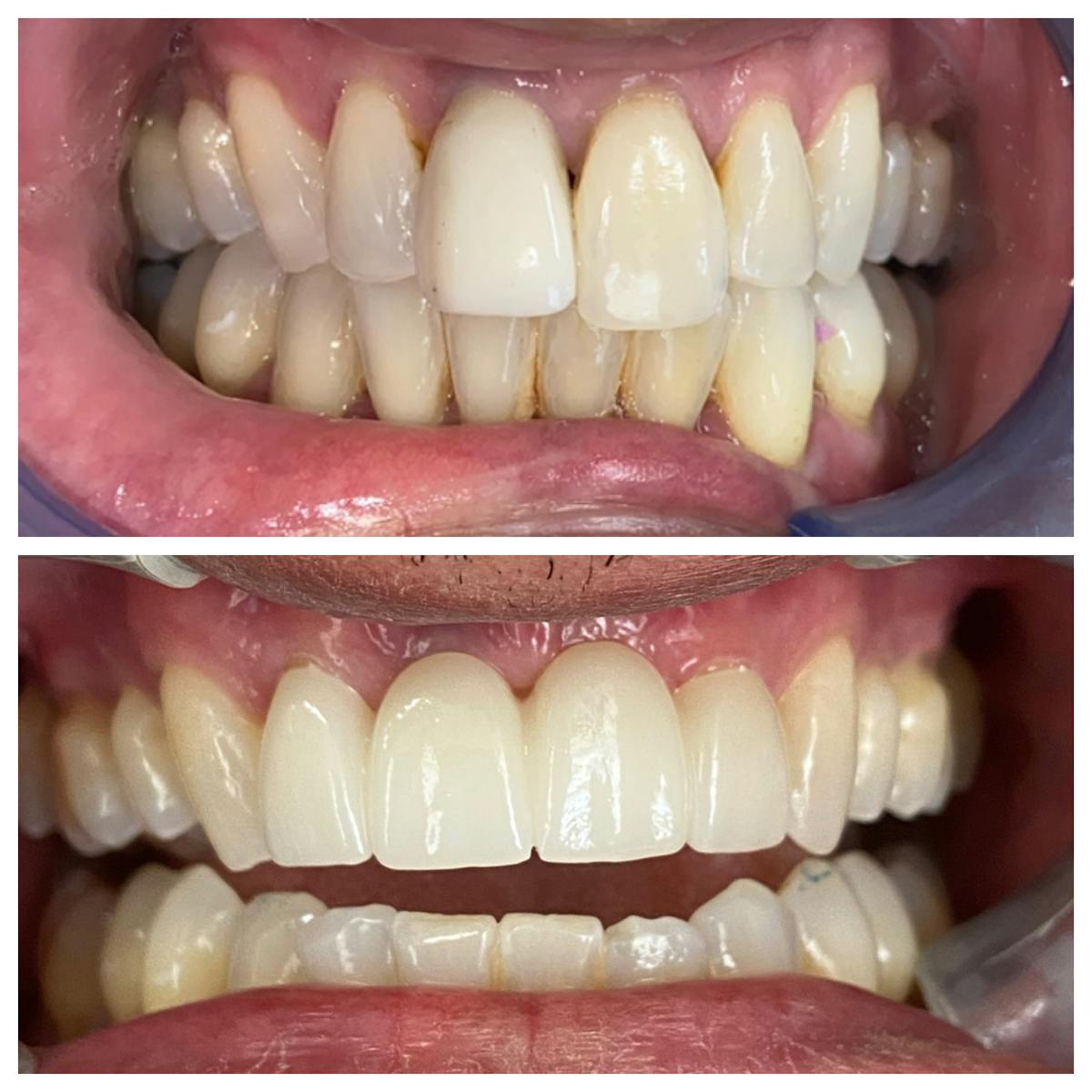 Crowns Before & After Gallery - Patient 86637820 - Image 2