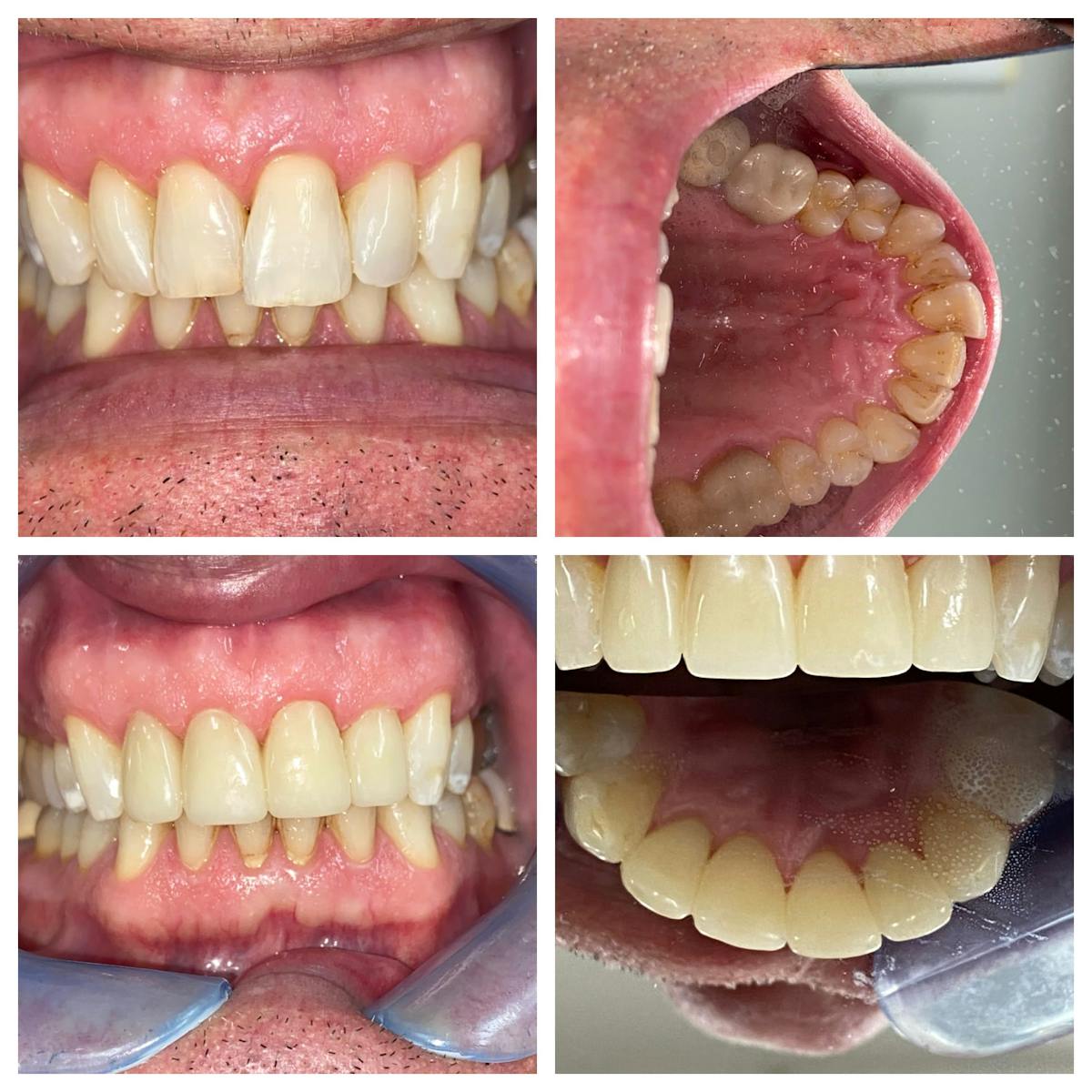 Crowns Before & After Gallery - Patient 86637821 - Image 2