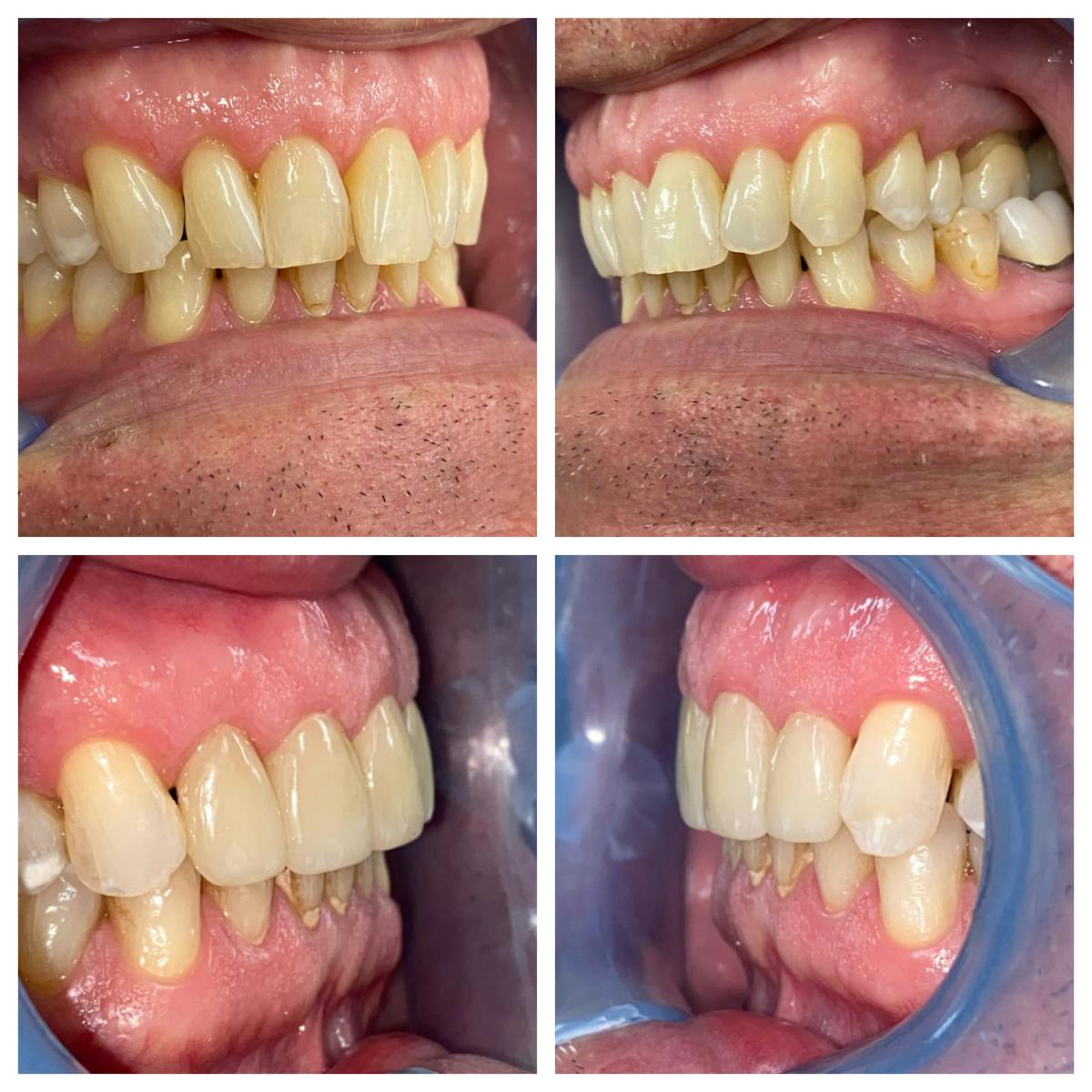 Crowns Before & After Gallery - Patient 86637821 - Image 3