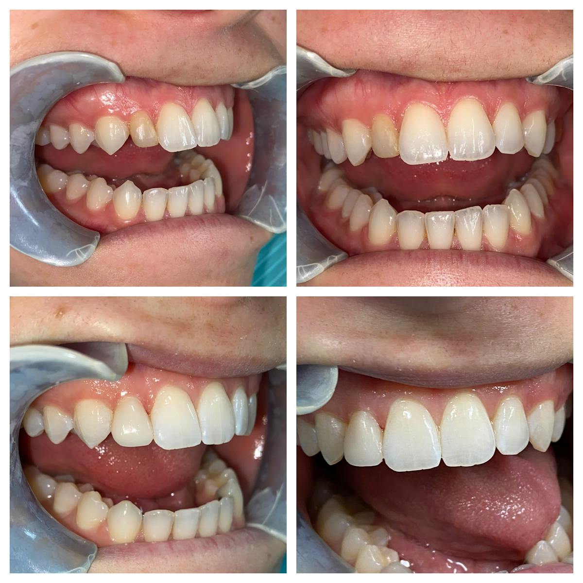 Crowns Before & After Gallery - Patient 86637822 - Image 1
